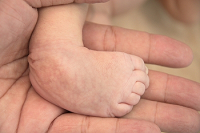 A Brief Overview of Congenital Foot Deformities