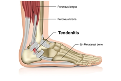 Causes and Relief Options for Achilles Tendonitis